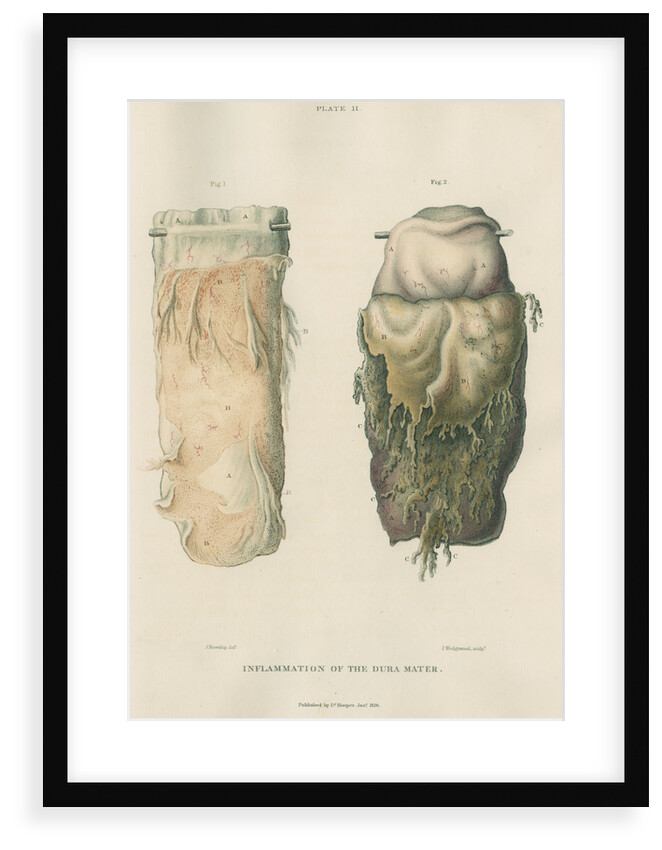 'Inflammation of the dura mater' by J Wedgewood