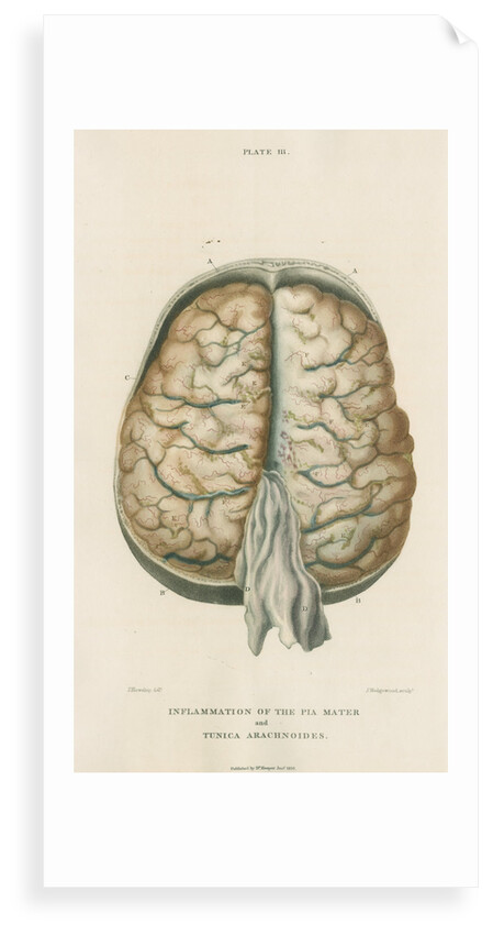 'Inflammation of the pia mater and tunica arachnoides' by J Wedgewood