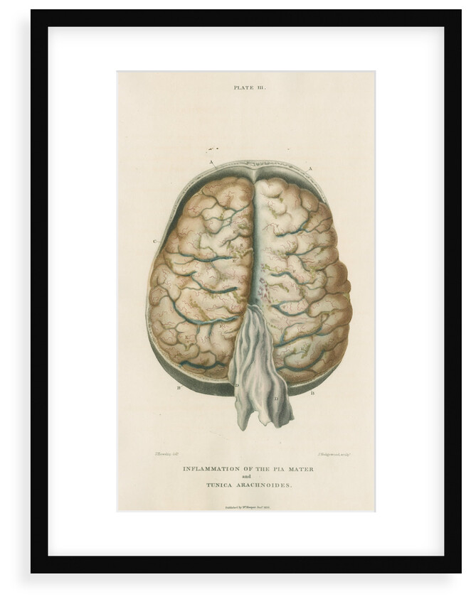 'Inflammation of the pia mater and tunica arachnoides' by J Wedgewood