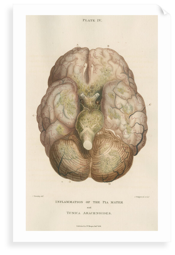 'Inflammation of the pia mater and tunica arachnoides' by J Wedgewood