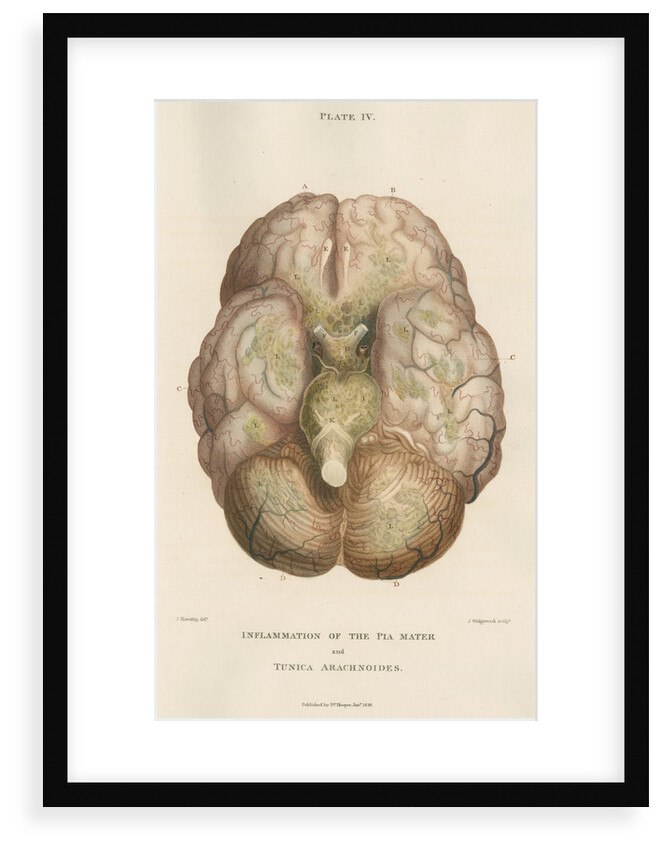 'Inflammation of the pia mater and tunica arachnoides' by J Wedgewood