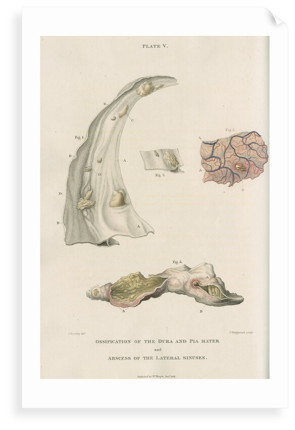 'Ossification of the dura and pia mater' by J Wedgewood