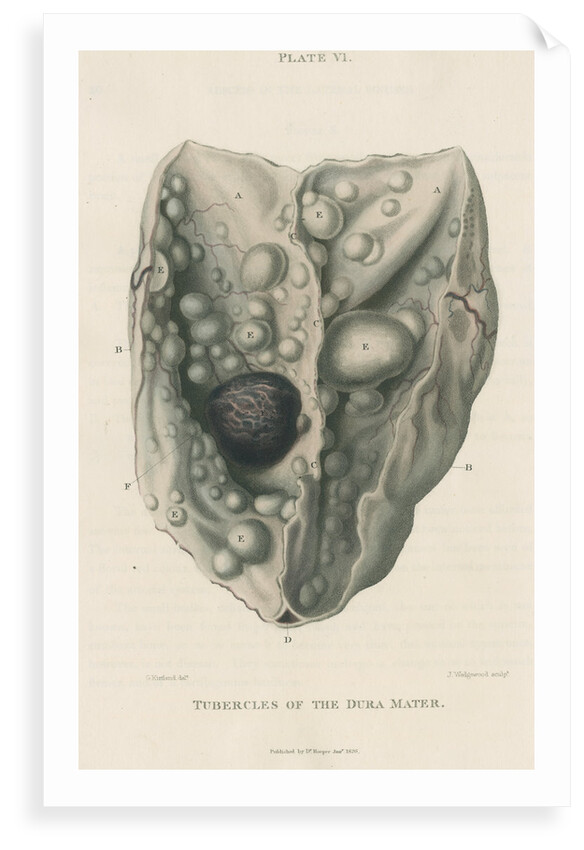 'Tumours of the dura mater' by J Wedgewood