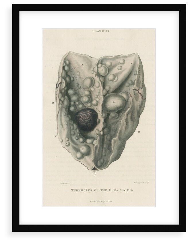 'Tumours of the dura mater' by J Wedgewood