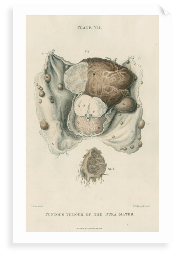 'Fungous tumour of the dura mater' by J Wedgewood