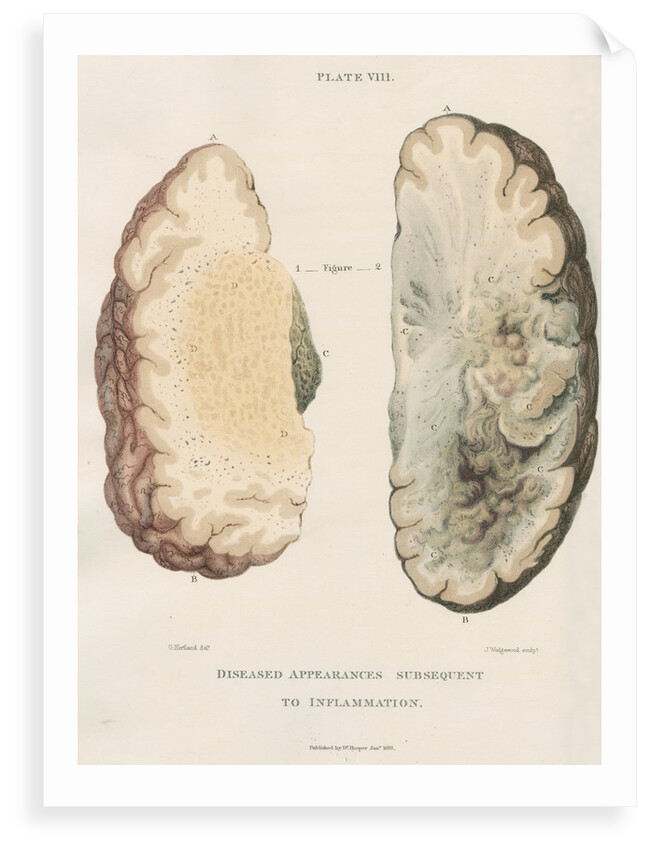 'Inflammation of the brain' by J Wedgewood