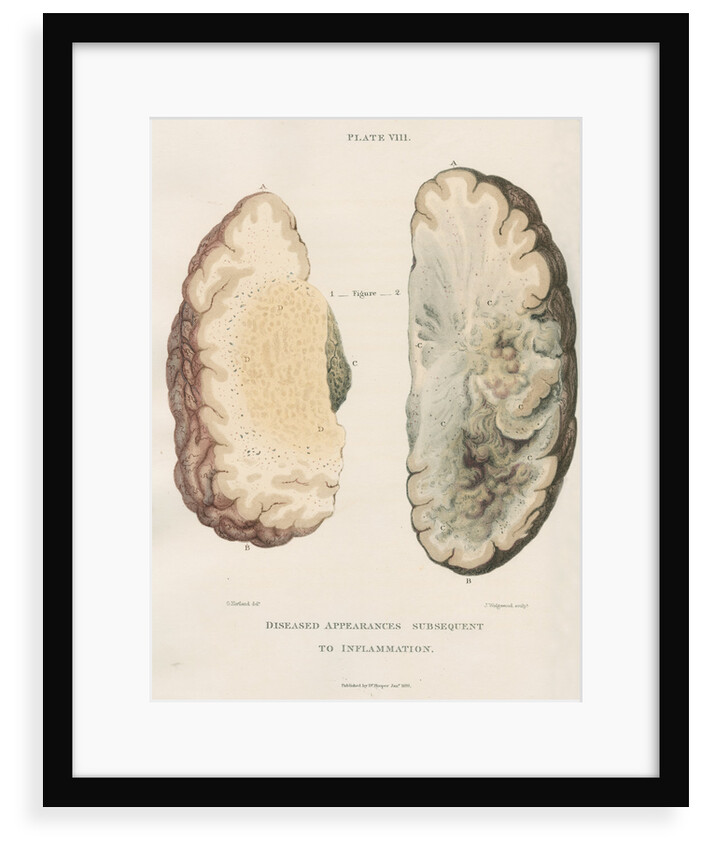 'Inflammation of the brain' by J Wedgewood
