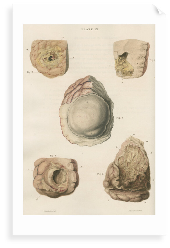 'Abscess of the brain' by J Stewart senior