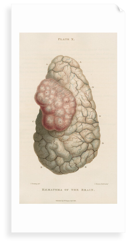 'Haematoma of the brain' by J Stewart senior