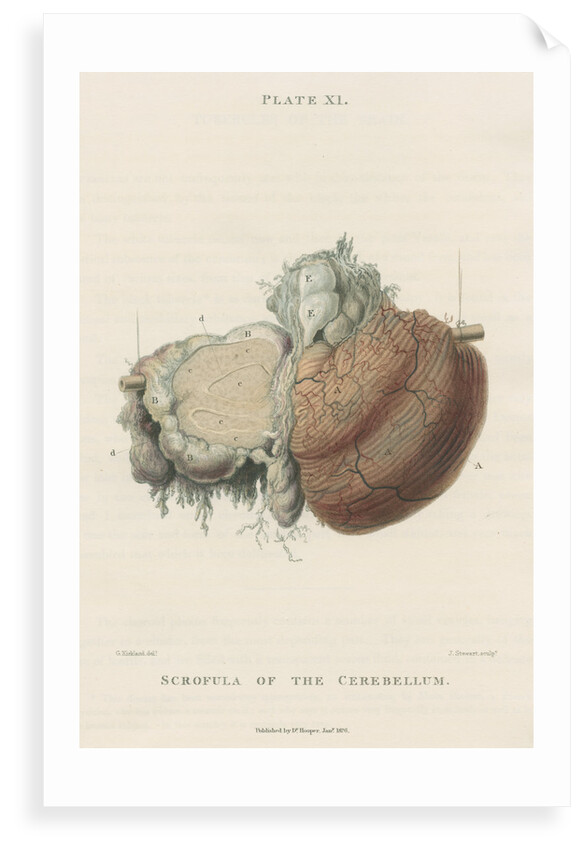 'Scrofula of the cerebellum' by J Stewart senior