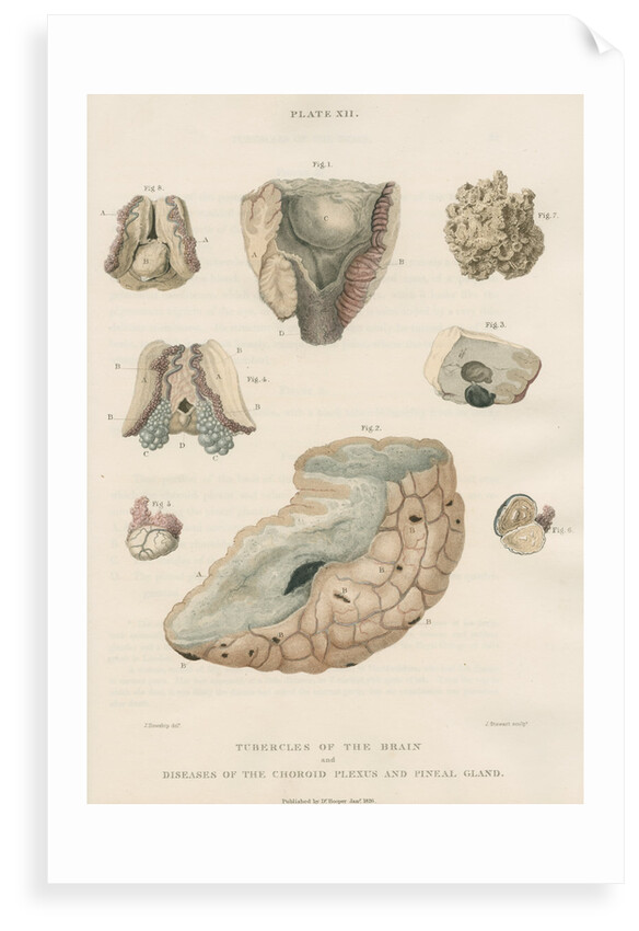 'Tubercles of the brain' by J Stewart senior