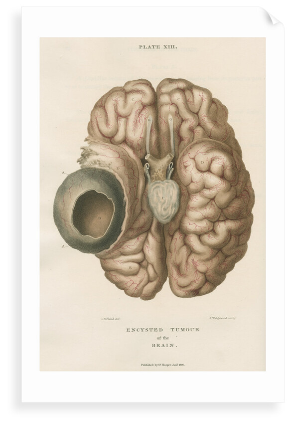 'Encysted tumour of the brain' by J Wedgewood