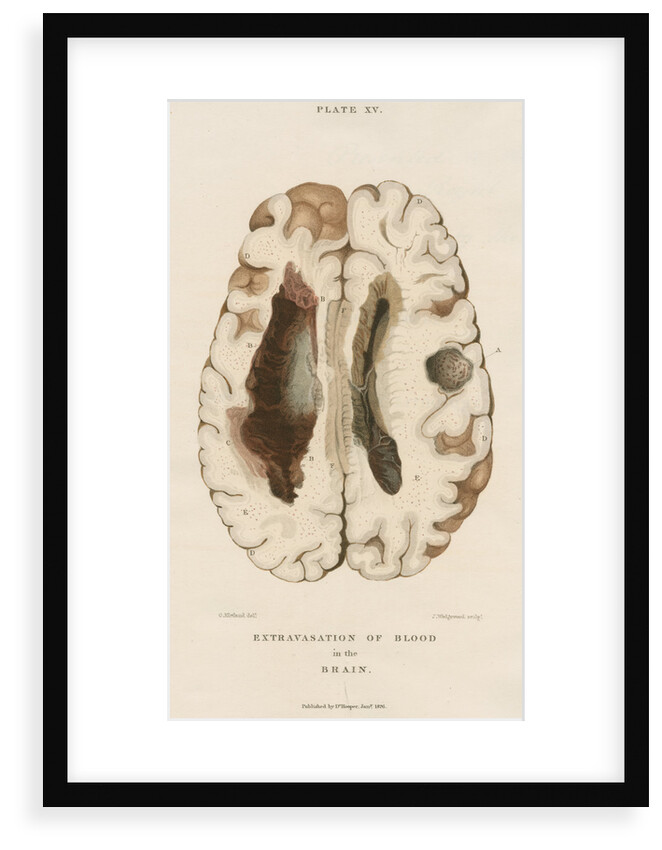 'Extravasation of the blood' by J Wedgewood