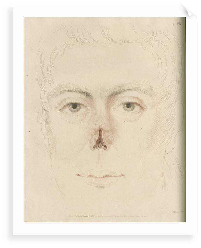 A candidate for a nose replacement by Charles Turner