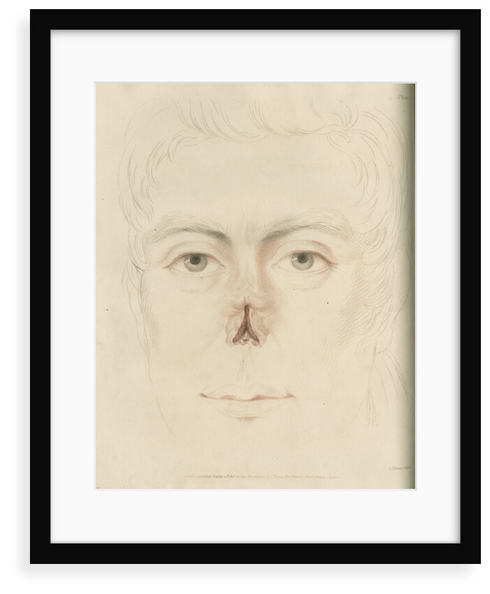 A candidate for a nose replacement by Charles Turner
