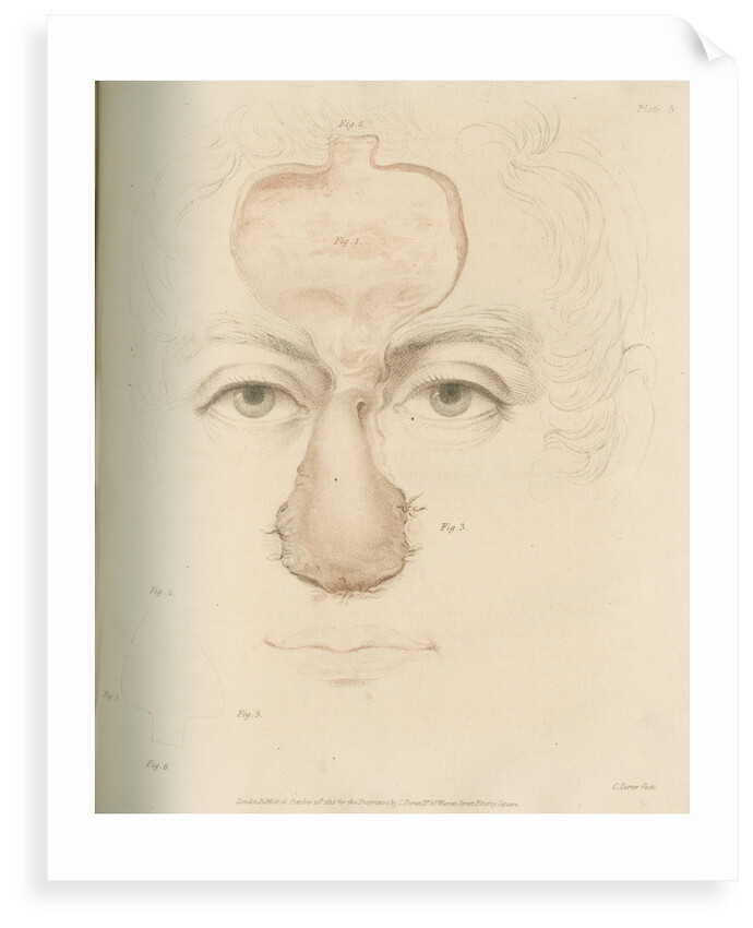 The Indian Method of nose replacement by Charles Turner