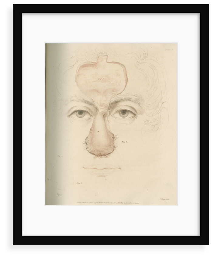 The Indian Method of nose replacement by Charles Turner
