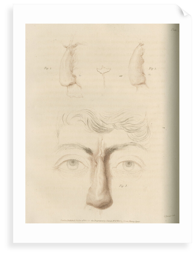 A successful nose replacement using the Indian Method by Charles Turner
