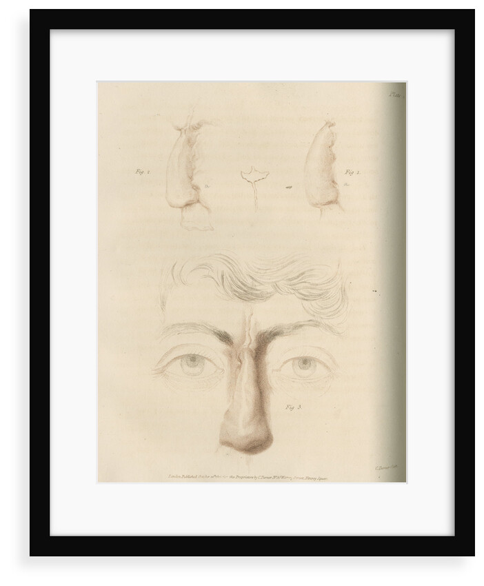 A successful nose replacement using the Indian Method by Charles Turner