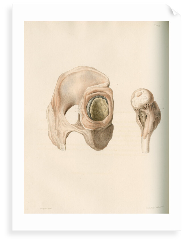 Hip and femur by G Hallmandel