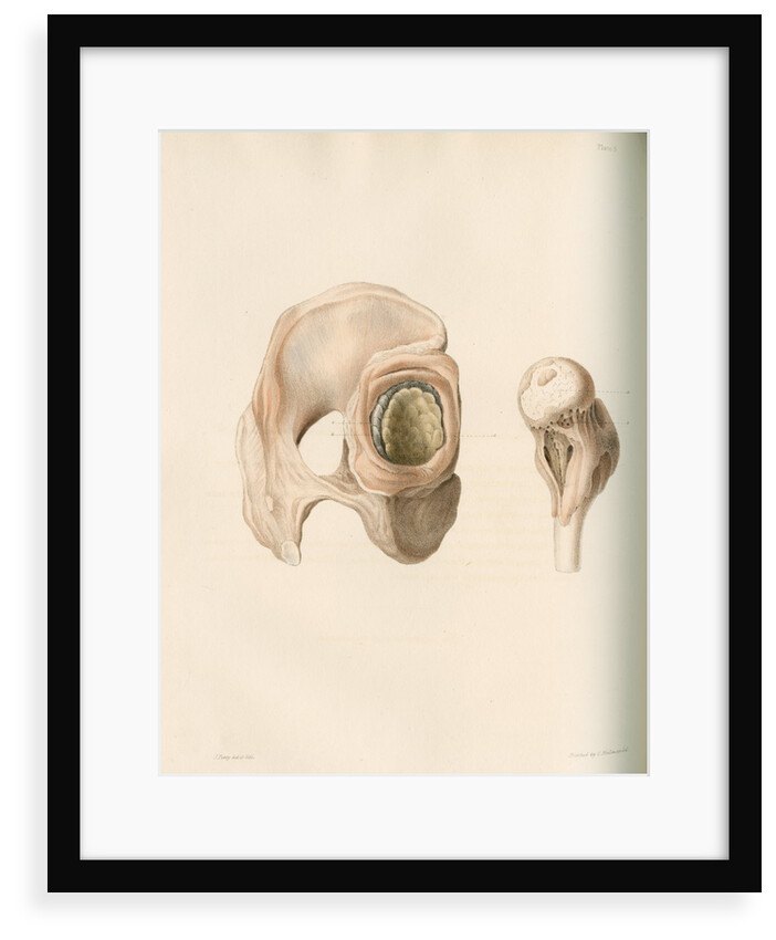 Hip and femur by G Hallmandel