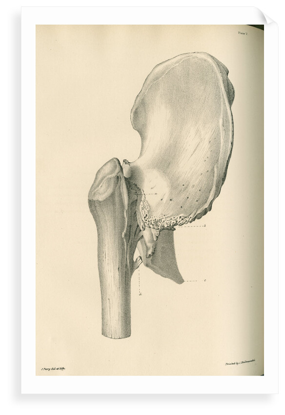 Lateral view of anchylosis of the right femur with the hip bone by J Perry