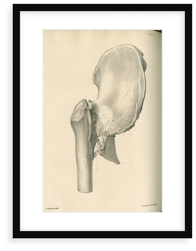Lateral view of anchylosis of the right femur with the hip bone by J Perry