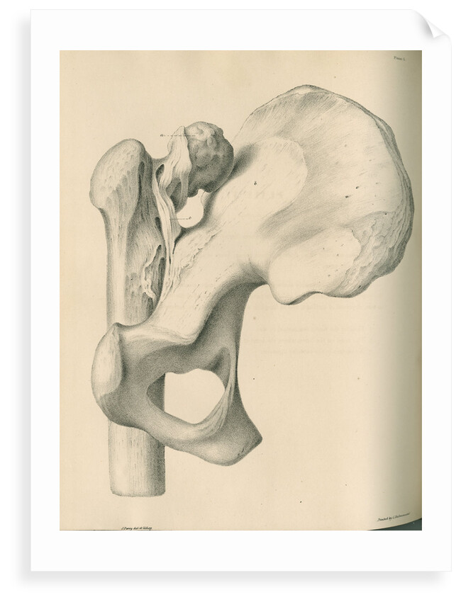 Posterior view of a left dislocated femur and hip bone by J Perry