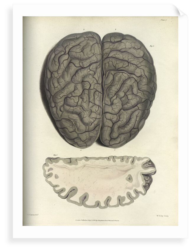 'Extreme cerebral congestion' by William Thomas Fry