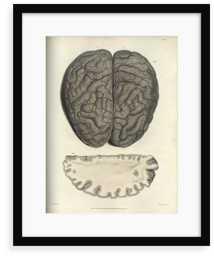 'Extreme cerebral congestion' by William Thomas Fry
