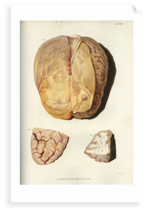 'Effects of jaundice on the brain and its membranes' by William Thomas Fry