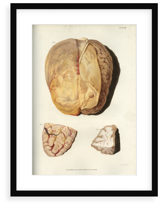 'Effects of jaundice on the brain and its membranes' by William Thomas Fry