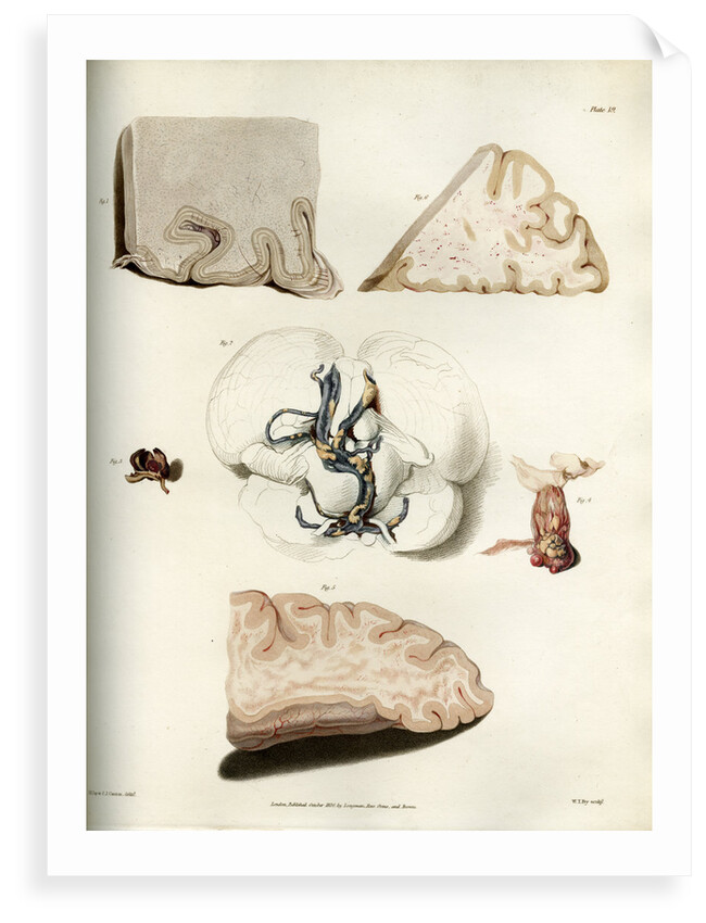 'Congestion in the minute vessels of the brain' by William Thomas Fry