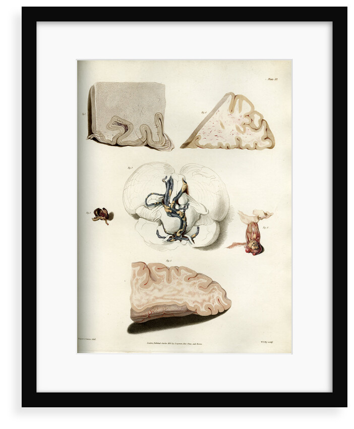 'Congestion in the minute vessels of the brain' by William Thomas Fry