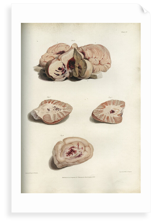 'Apoplexy and concussion' by C J Canton