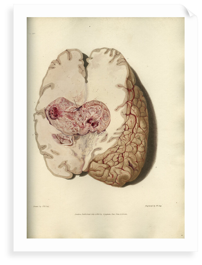 'Cyst in the brain' by William Say
