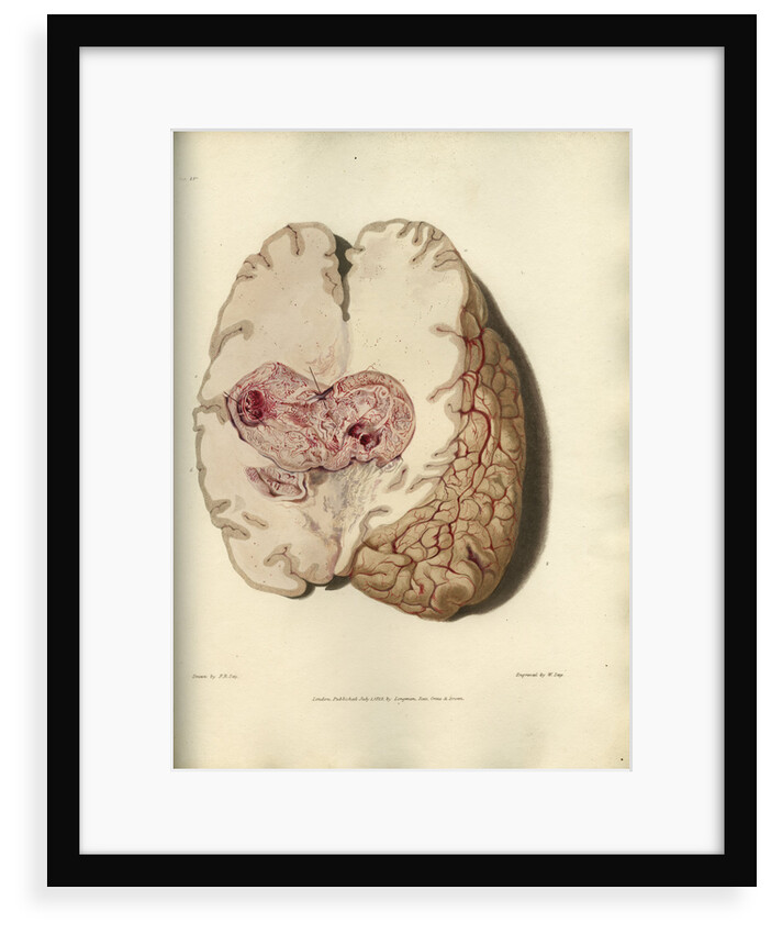 'Cyst in the brain' by William Say
