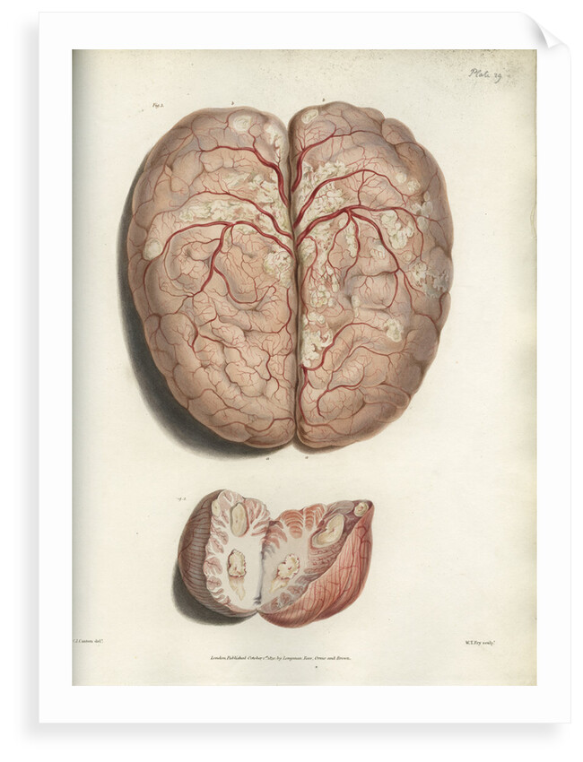 'Scrofulous tubercles in the brain' by C J Canton