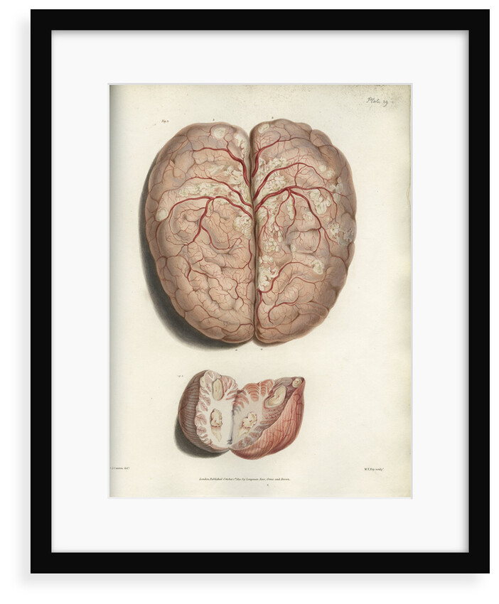 'Scrofulous tubercles in the brain' by C J Canton