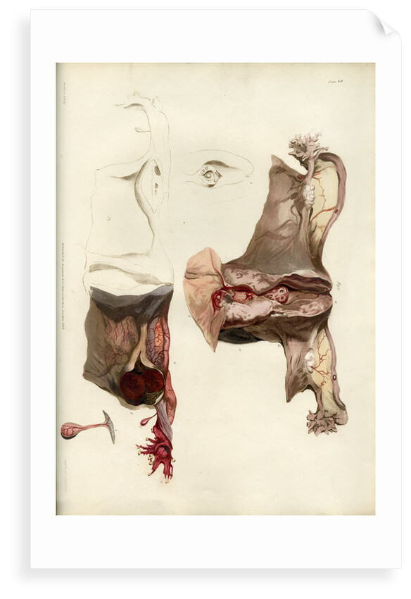 'Diseases of the uterus giving rise to excessive nervous irritation' by C J Canton