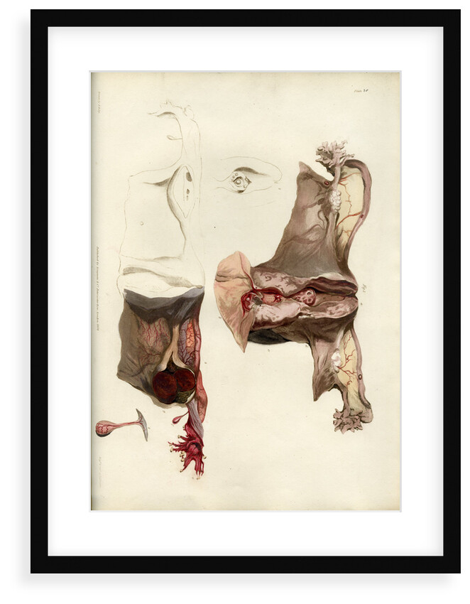 'Diseases of the uterus giving rise to excessive nervous irritation' by C J Canton
