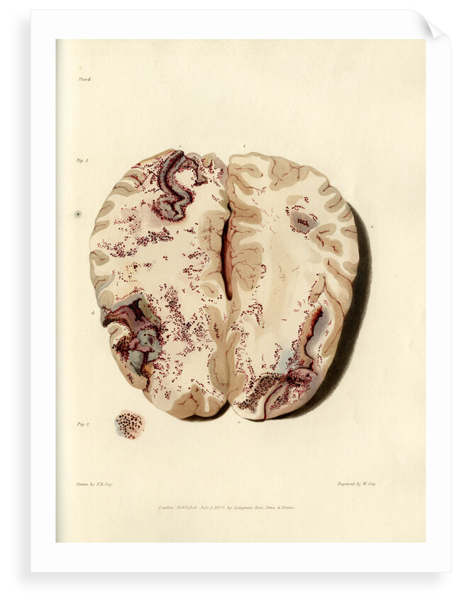 'Extravasion in the brain from obstructed circulation' by William Say
