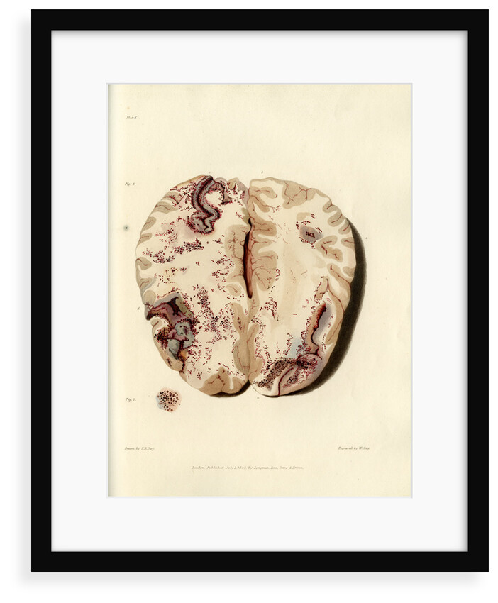 'Extravasion in the brain from obstructed circulation' by William Say