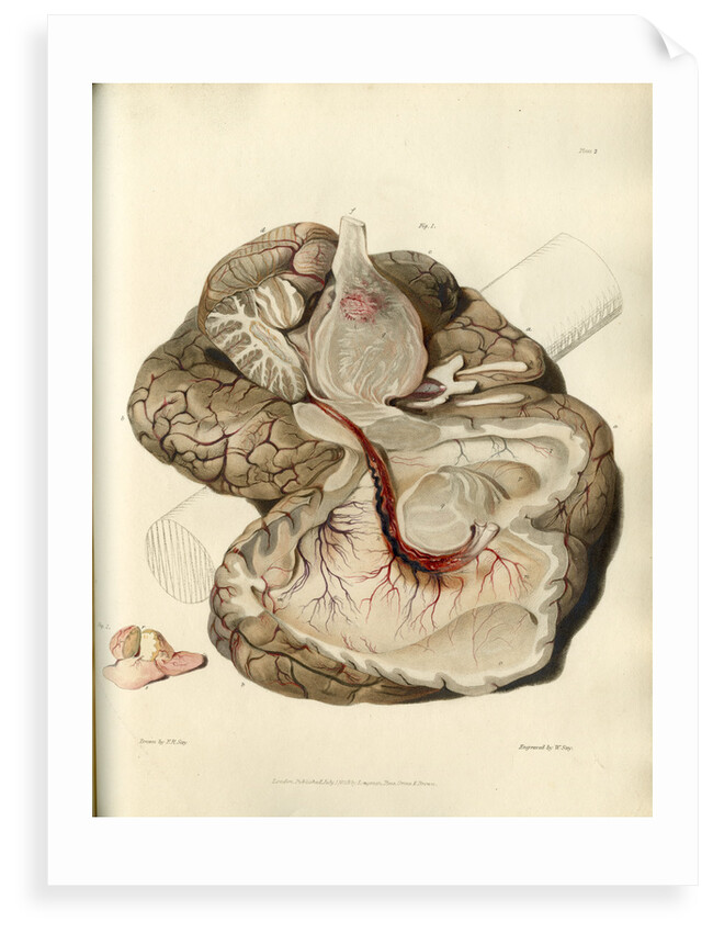 'Tumour of the pons Varolii' by William Say