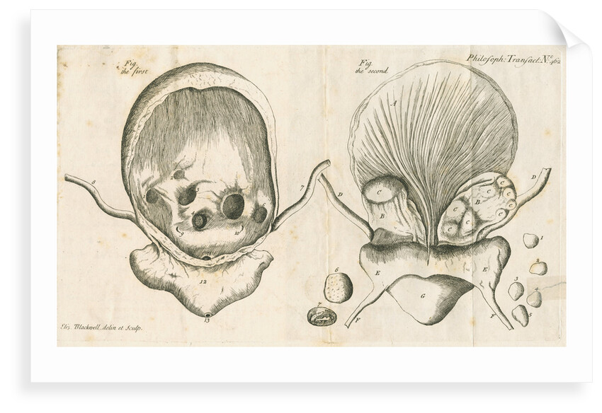 Human bladder and bladder stones by Elizabeth Blackwell