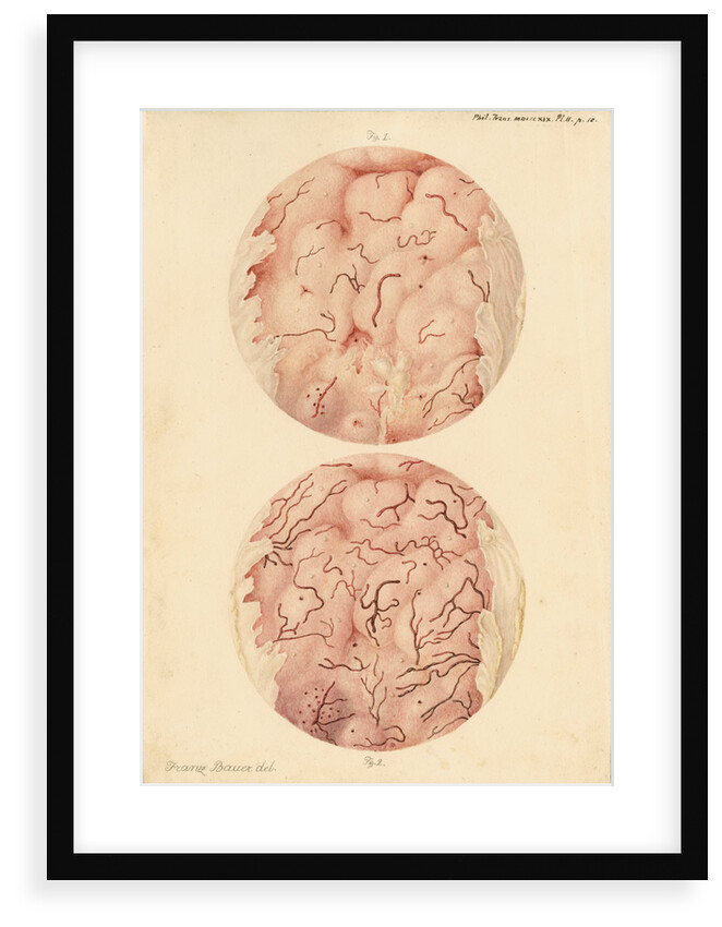 Superficial sore on a human leg by Franz Andreas Bauer