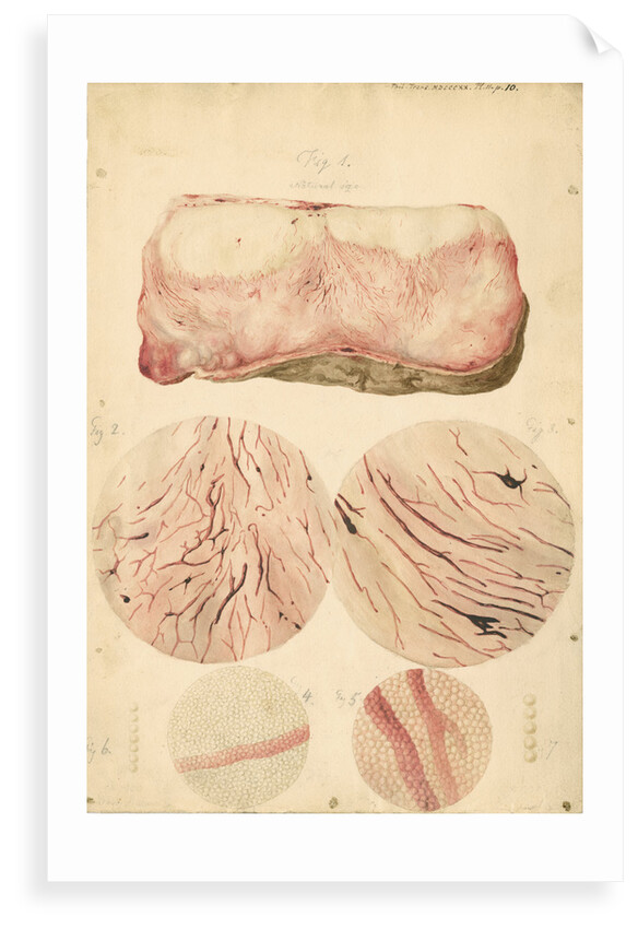 Tumor with human blood lymph cells by Franz Andreas Bauer