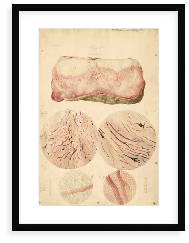 Tumor with human blood lymph cells by Franz Andreas Bauer