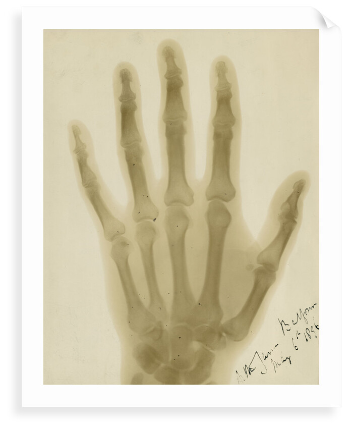 X-ray photograph of the hand of Arthur James Balfour by Alan Archibald Campbell Swinton