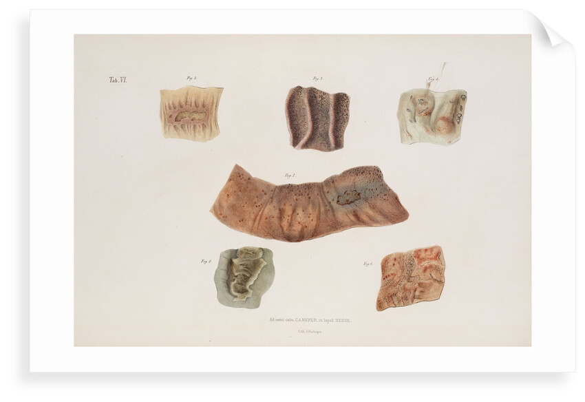 Alterations caused by cholera in the intestinal mucous membrane by d'Harlingue